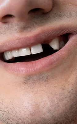 Patient in Sandown smiling with missing tooth
