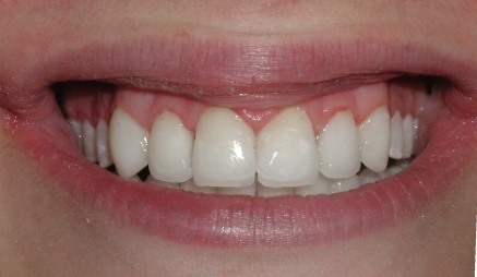 Smile with evenly spaced teeth