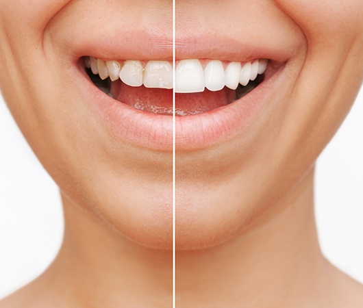 Woman’s smile before and after veneers 