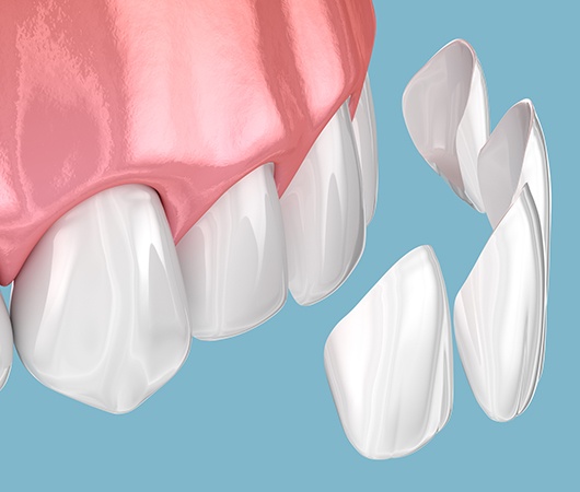 Closeup of veneers being placed on teeth 